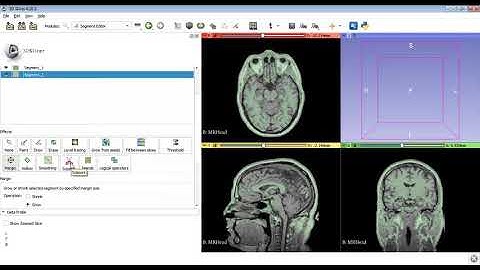 Skull Stripping in 3D Slicer