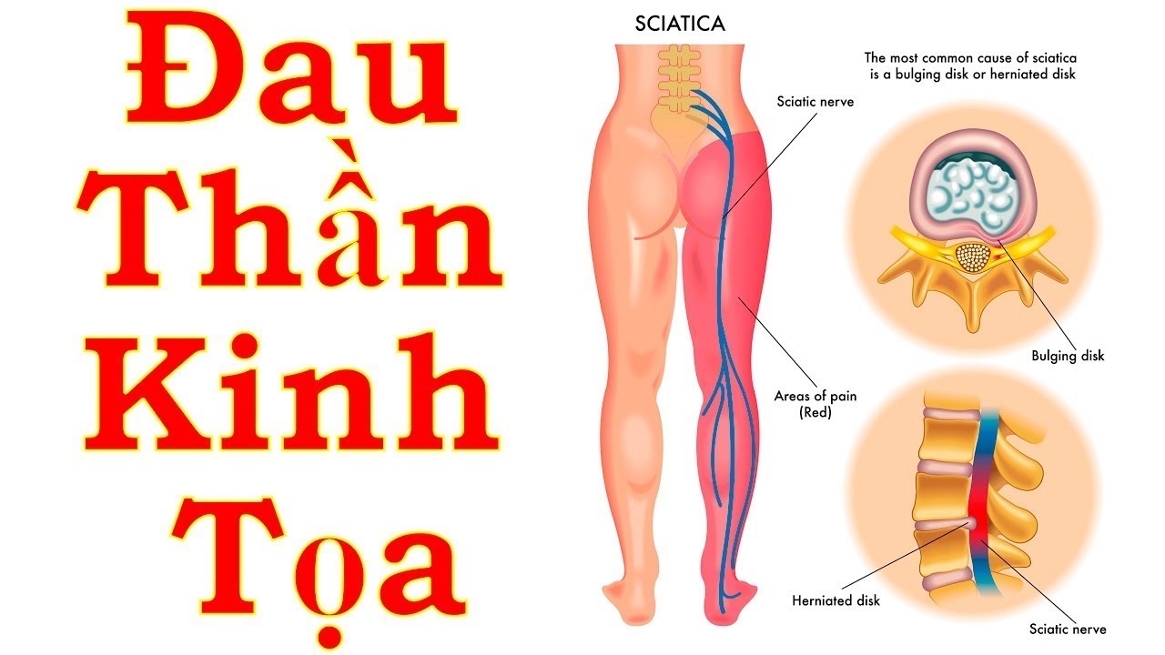 Đau Thần Kinh Tọa Là Gì? Nguyên Nhân – Triệu Chứng Và Cách Điều Trị