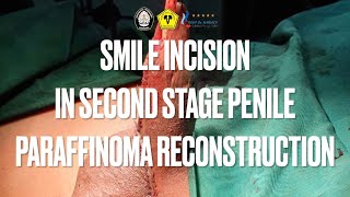 SMILE INCISION MODIFIED TECHNIQUE IN THE 2ND STAGE OF PENILE PARAFFINOMA RECONSTRUCTION Eps.3