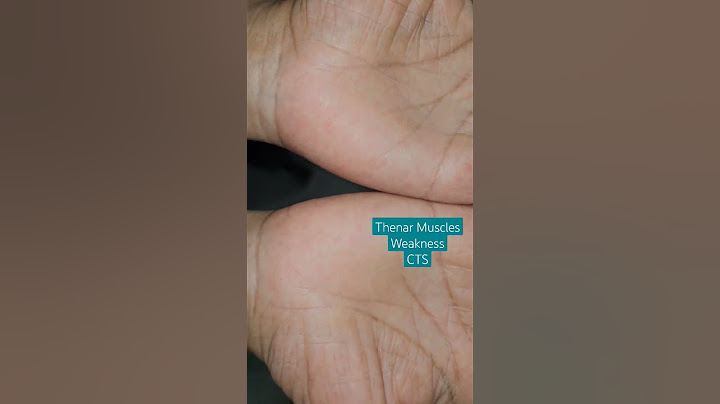 Thenar Muscles weakness in Carpal Tunnel Syndrome #Thenar #Hypothenar #Muscles #CTS