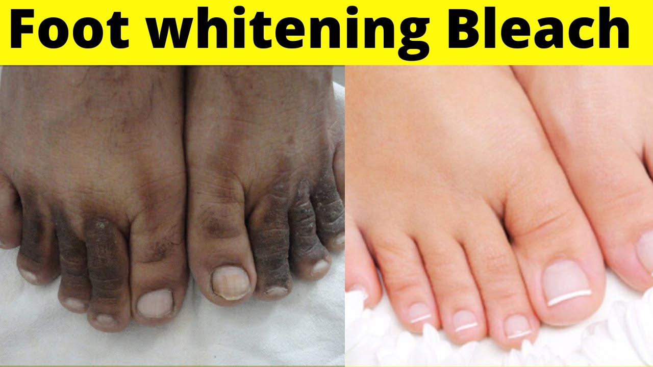 Foot whitening Bleach Formula Instant Foot Bleach YouTube