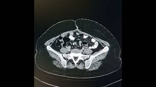 Parastomal hernia +Hepatic metastases. Parastomal Hernia By David Rivadeneira Md Preview