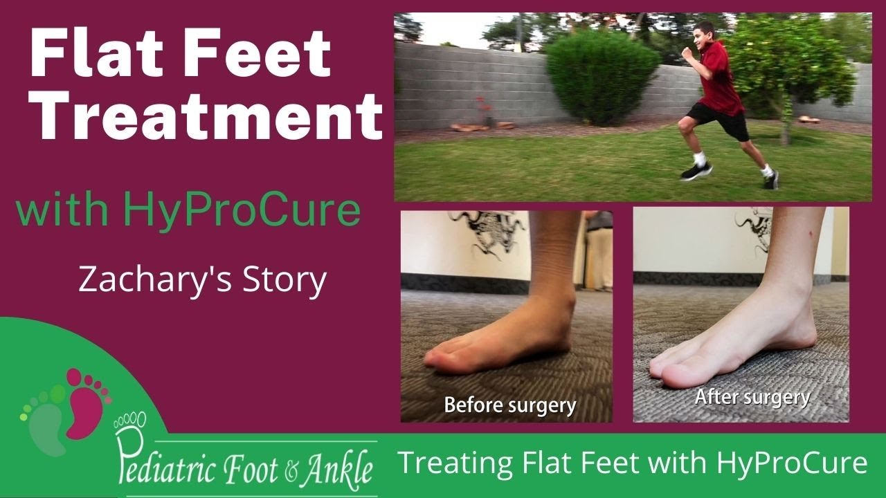 Flat Feet Correction with HyProCure Surgery Zachary's Story - YouTube