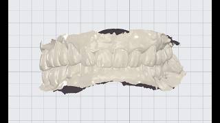 Digital Diagnosis for Anterior Teeth l Chairside Clinical CAD/CAM