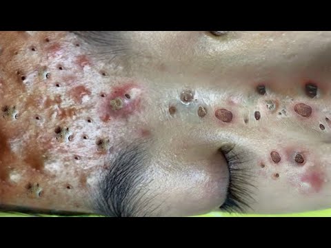 Loan Nguyen Acne Treatment 14677