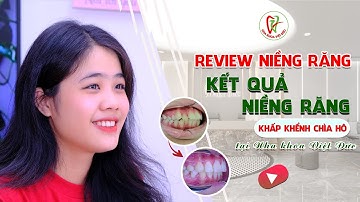 Review Niềng Răng: Kết Quả Niềng Răng Khấp Khểnh - Chìa Hô