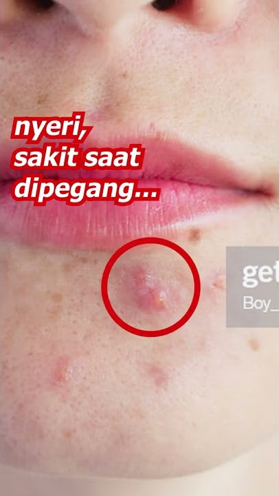 5 Jenis Jerawat yang WAJIB DIKETAHUI   SOLUSINYA