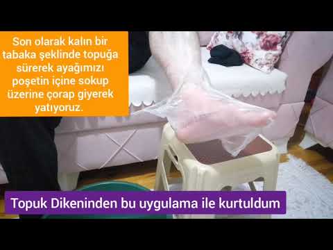 TOPUK DİKENİNDEN BU UYGULAMA İLE KURTULDUM