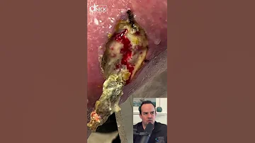DOCTOR REACTS TO DEAD TISSUE REMOVED FROM WOUND Shorts Satisfying 