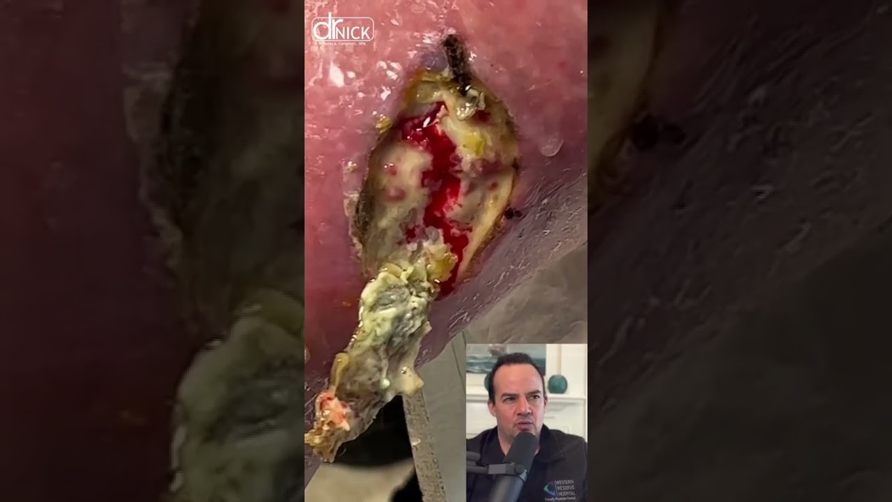 DOCTOR REACTS TO DEAD TISSUE REMOVED FROM WOUND😱! #shorts #satisfying