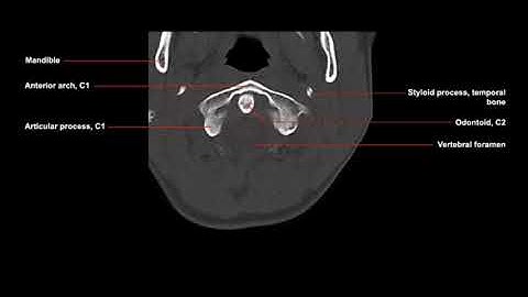 Recognizing anatomy on an axial CT scan of the cervical spine: Cross-sectional anatomy made easy