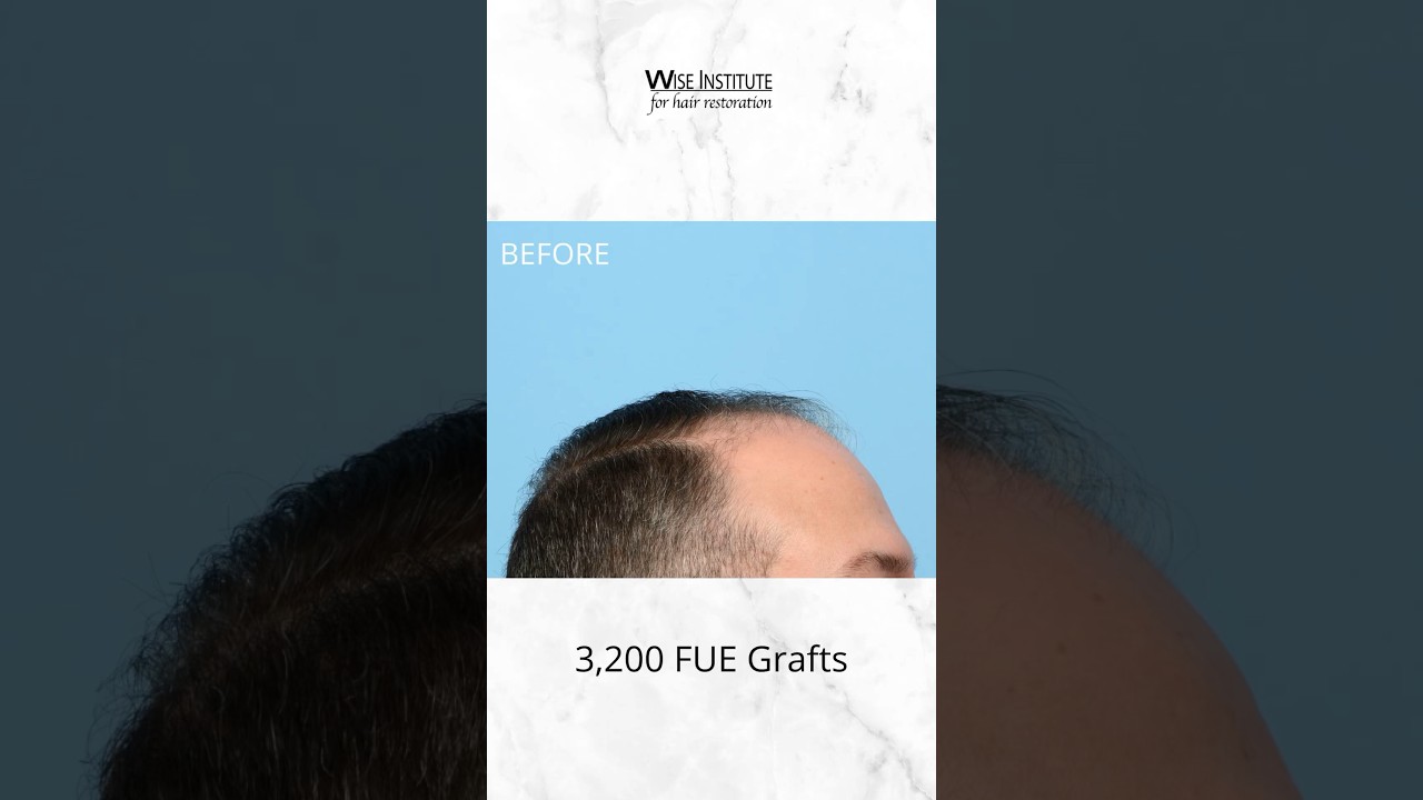3,200 FUE grafts later.. say goodbye to hair loss with an FUE Hair Transplant. 