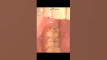 إجراء حشو ضرس العقل 