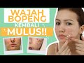 Bekas Jerawat Membandel Jadi Bopeng? Jangan Panik, Ini Solusinya!