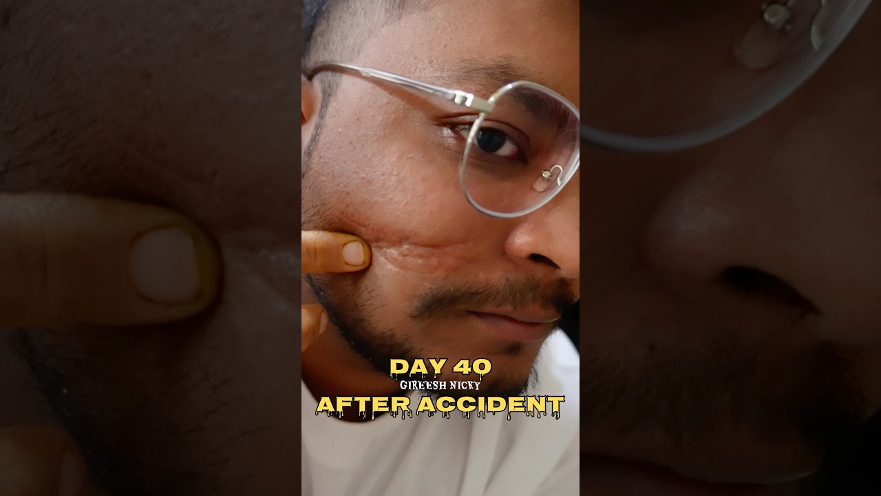 Day 40 ❤️‍🩹 Recovery Journey | Benfits of Hot water therapy 