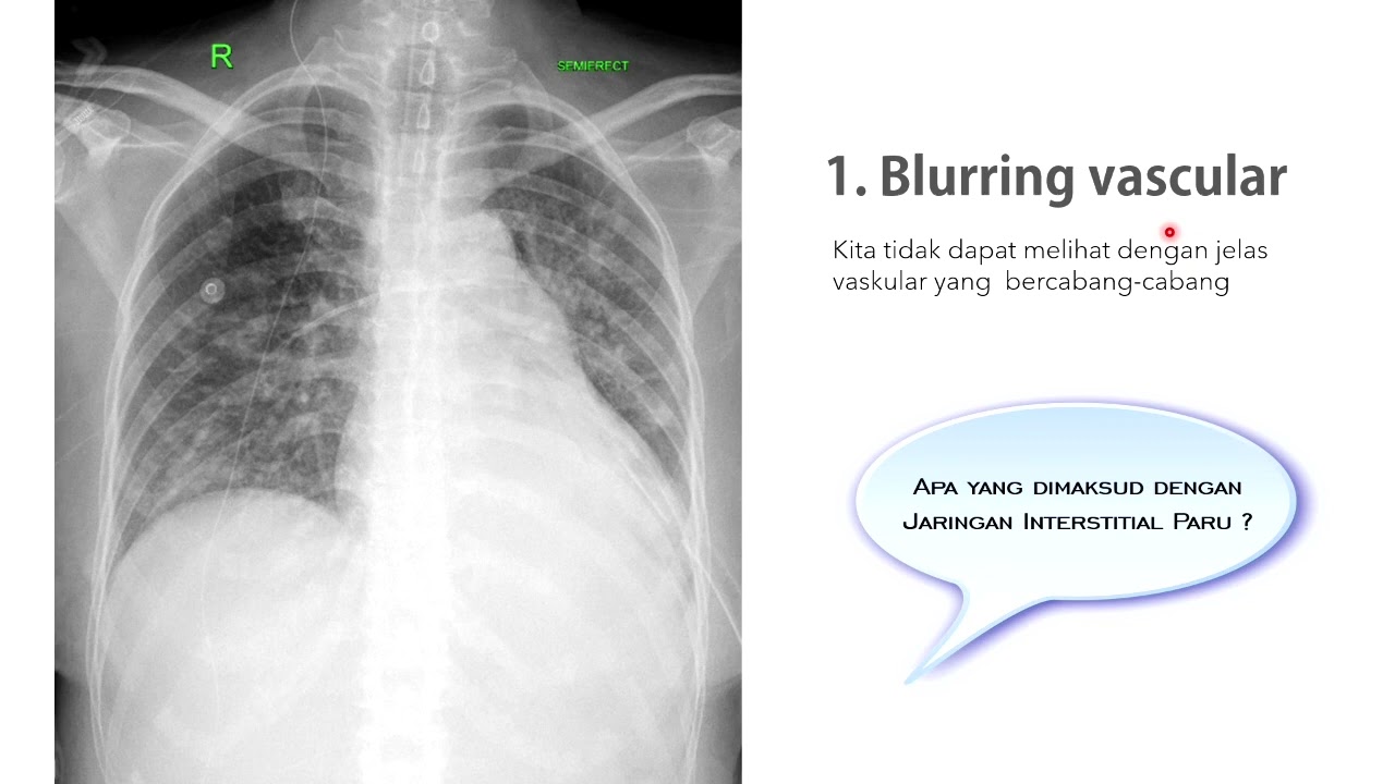 Bagaimana gambaran radiologi oedem pulmo ?