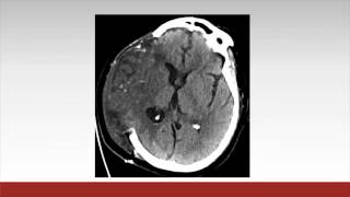 Neurocritical Care Considerations After Cardiac Surgery