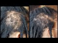 THREE MONTHS OF HAIR GROWTH ON DAMAGED AREA