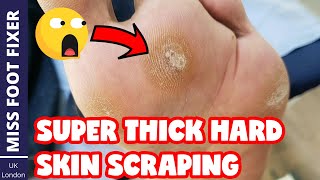 SUPER THICK HARD SKIN SCRAPING *** Callous Removal From Feet *** Full Treatment By Miss Foot Fixer