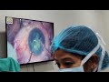 #cataract surgery (phaecoemulcification) #ophthalmology by Dr Sanjeev tiriya Sir 
