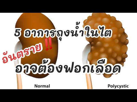 วีดีโอ: วิธีการรักษาโรคไต Polycystic ที่โดดเด่น autosomal: 9 ขั้นตอน
