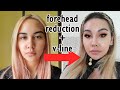 Forehead reduction + threadlift VLOG | Plastic Surgery