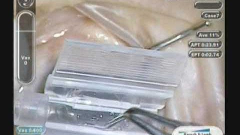 2.2mm Injection System for Akreos AO60 May 2010.wmv