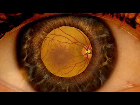 Video: Degenerarea Nervului Retinian și Optic în α-mannosidoză