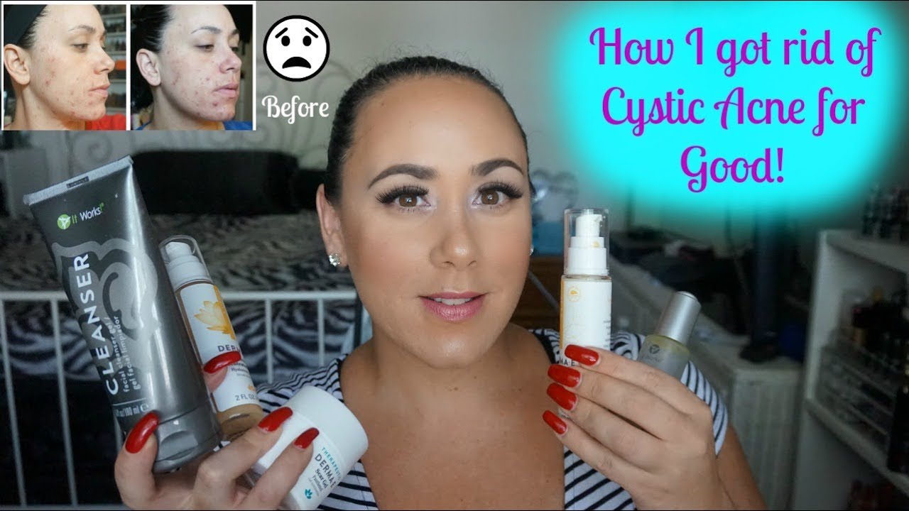How I Got Rid of Cystic Acne for Good! | Current Skincare Routine - YouTube
