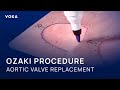 Aortic Valve Replacement: Ozaki Procedure Explained in 3D