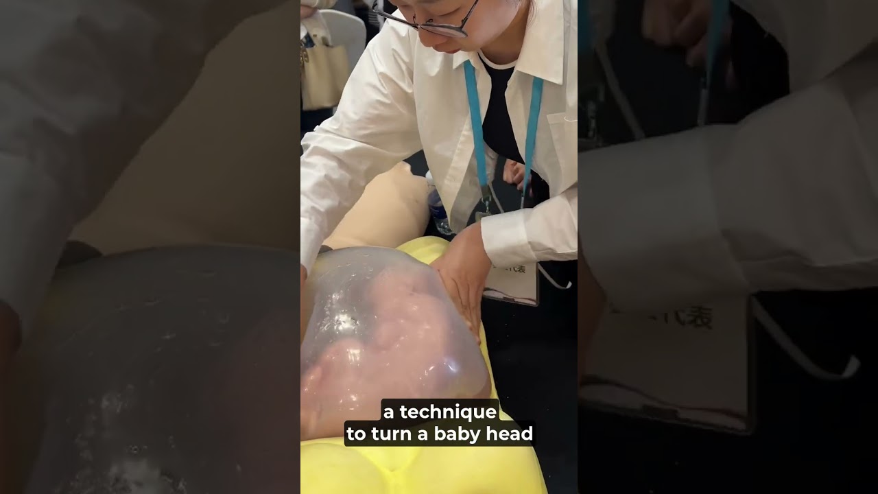 Live ECV Technique - Turning a Breech Baby