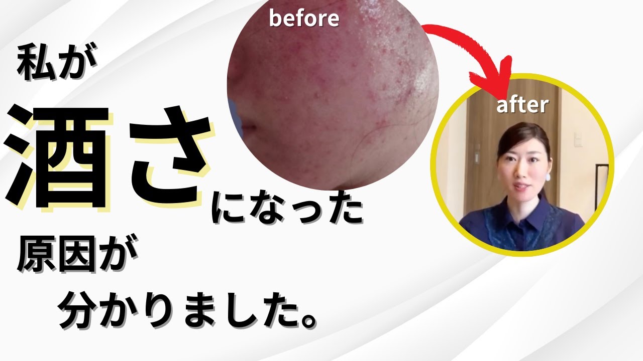 【酒さ】酒さになる人の特徴vol.