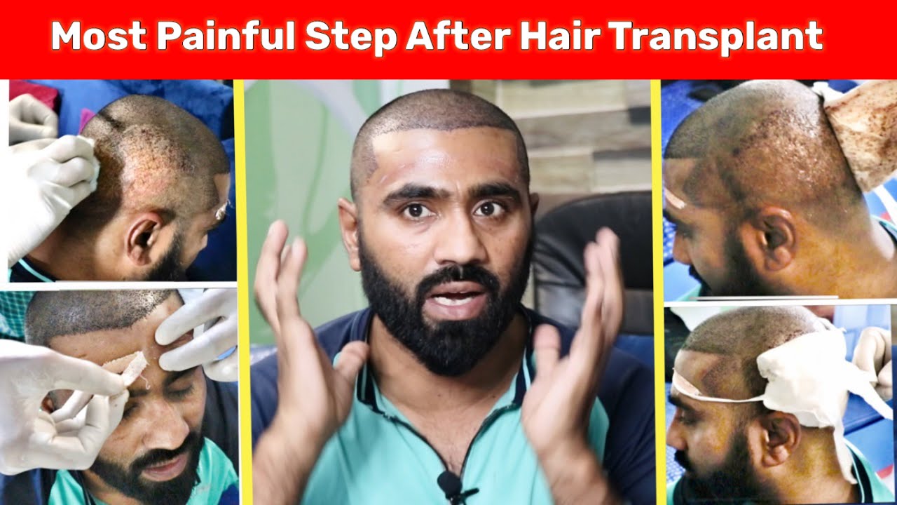 Day 4 Removing Bandage After Hair Transplant ये गलती मत कर देना