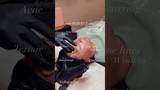 Why Is The Perfect Derma Peel So Effective?