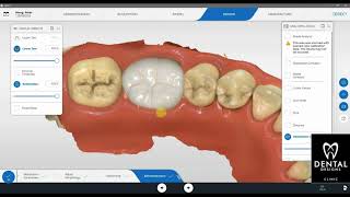 Dental Crown Singapore - Cerec Crown Design With Primescan