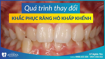 Niềng răng mắc cài kim loại - khắc phục răng hô khấp khểnh | Nha khoa quốc tế Athena