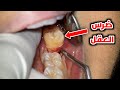 شاهد ازاي بيتم ازالة ضرس العقل Wisdom Tooth Removal Procedure 