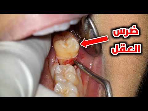 شاهد ازاي بيتم ازالة ضرس العقل Wisdom Tooth Removal Procedure