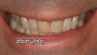 Smile Makeovers - Agnini Family Dental