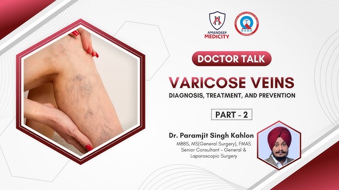 Varicose Veins Explained by Dr. Paramjit Singh Kahlon Part-1