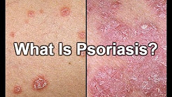 What Is Psoriasis | Symptoms | Treatments | Causes | Pictures | Types