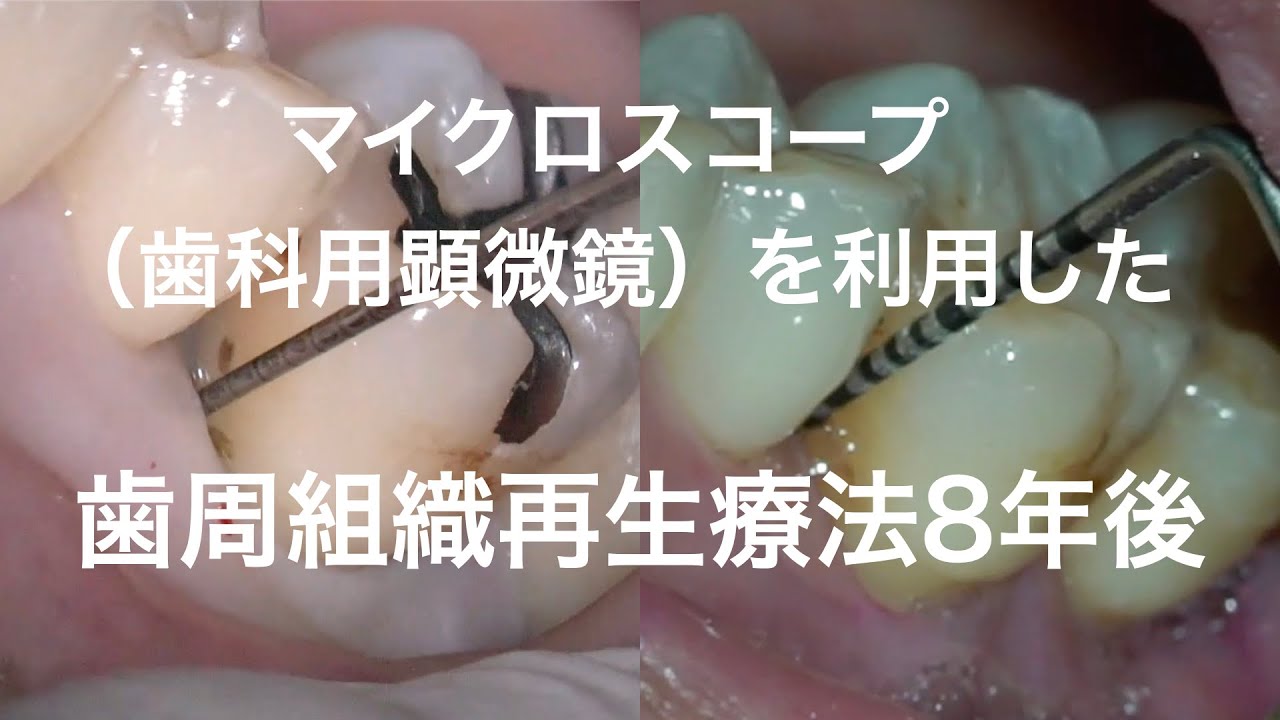 歯周組織再生療法術後8年後 - YouTube