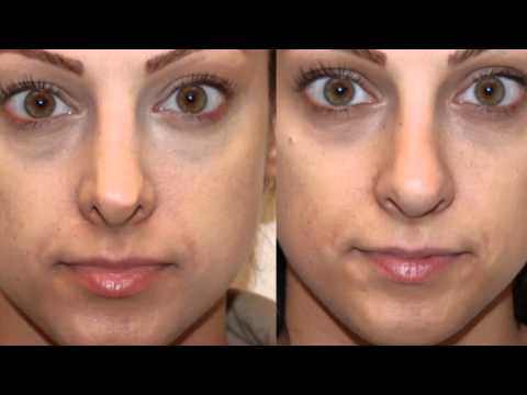 Video thumbnail: NonSurgical RevisionRhinoplasy — Eric M. Joseph, M.D.