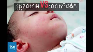 លក្ខណៈសម្គាល់ខុសគ្នា​ រវាងគ្រុនឈាម និងរលាកបំពង់ក!