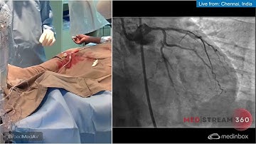 IVUS-guided PCI to LAD and OM