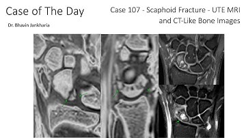 Case of the Day - 107 - 2025 09 23 - Scaphoid Fracture - UTE MRI and CT-Like Bone Images