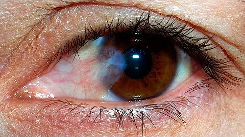 ¿Cómo puede saber si la diabetes está afectando a sus ojos?