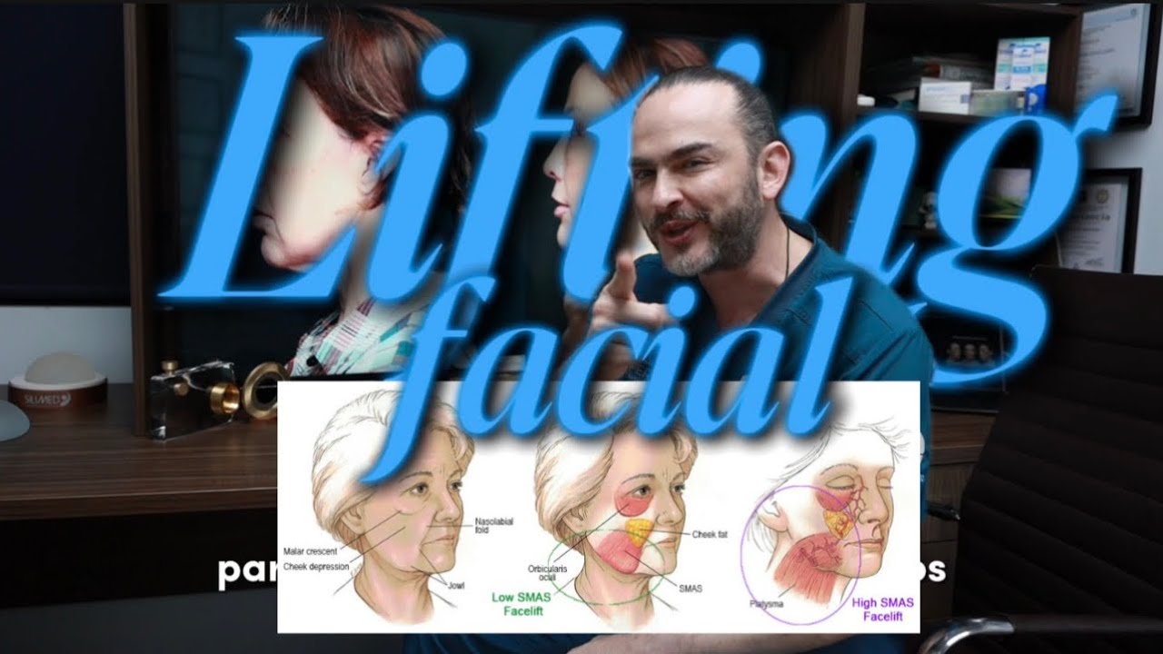 Lifting facial - ¿Qué es? Todos los detalles + Caso real