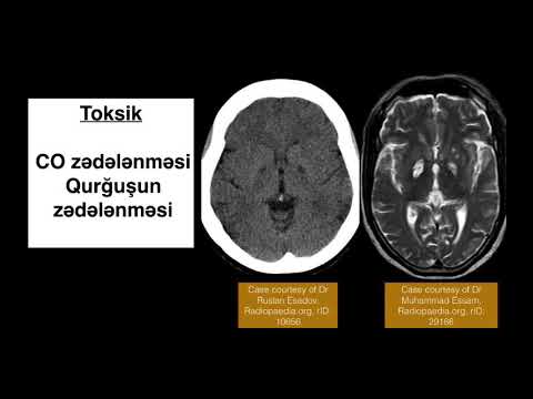 Video: Yaşlanmanın əksi nədir?