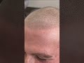 HAIR TATTOO zoom in 👀🔍 #scalpmicropigmentation #hairloss #micropigmentation #shorts